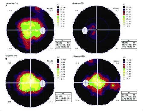 automated perimetry test results interpretation|Standard Automated Perimetry .